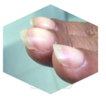 <p>What’s this called &amp; what’s it a sign of </p>