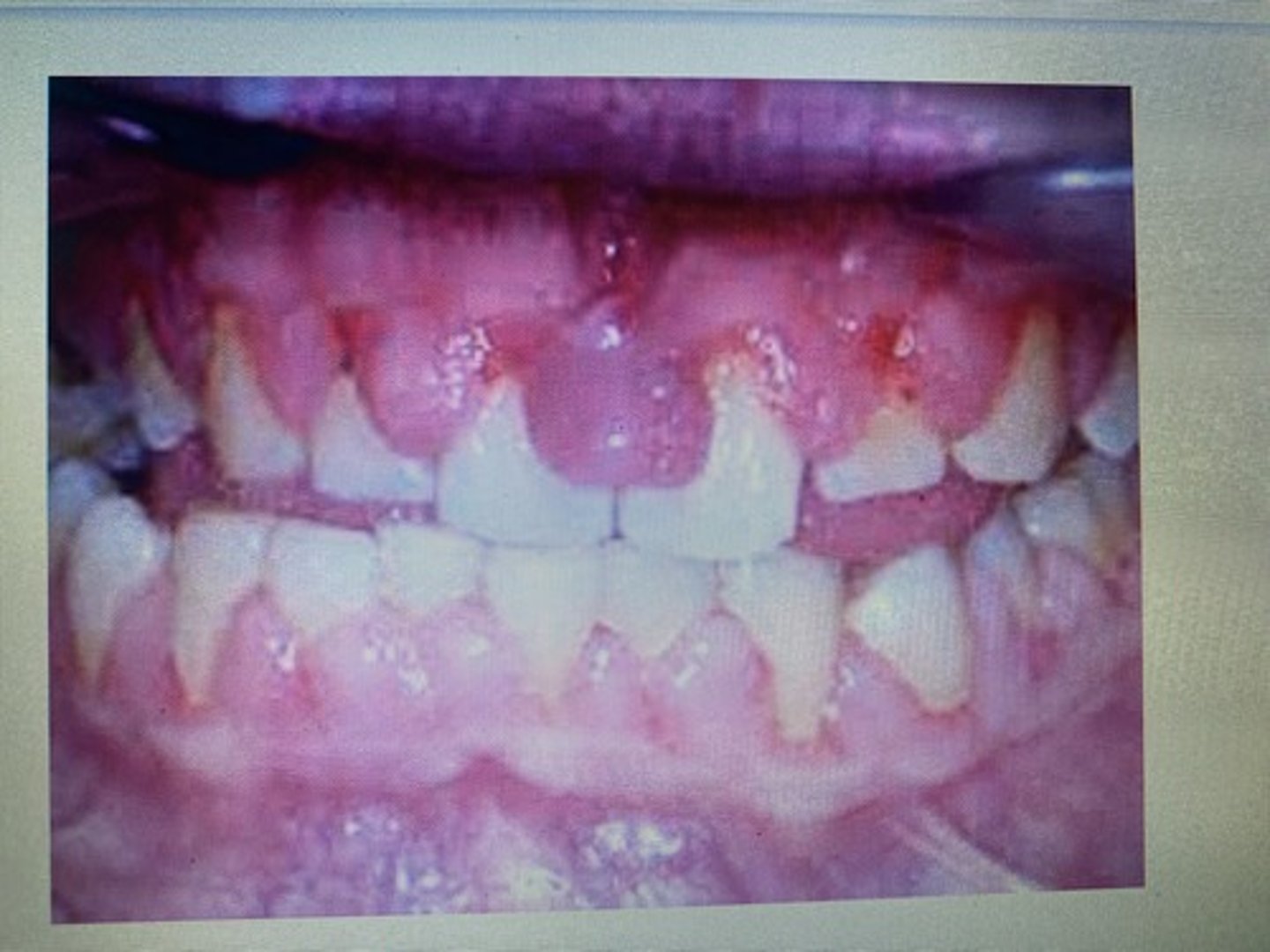 <p>Gingival Hyperplasia</p>