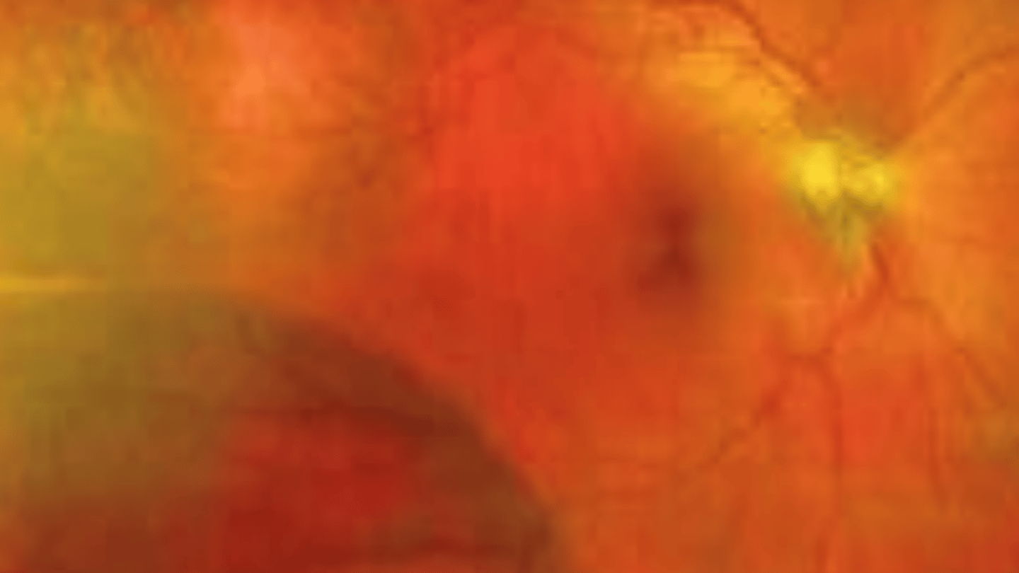 <p>retinoschisis that appears as a thin, transparent, ballooning of the retina filled with hyaluronic acid and not moving with eye movement. Has a small association with retinal detachment.</p>