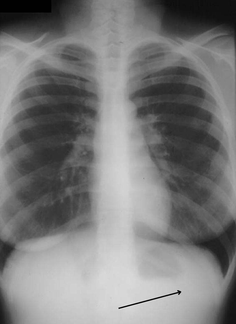 <p>left or right hemidiaphragm</p>