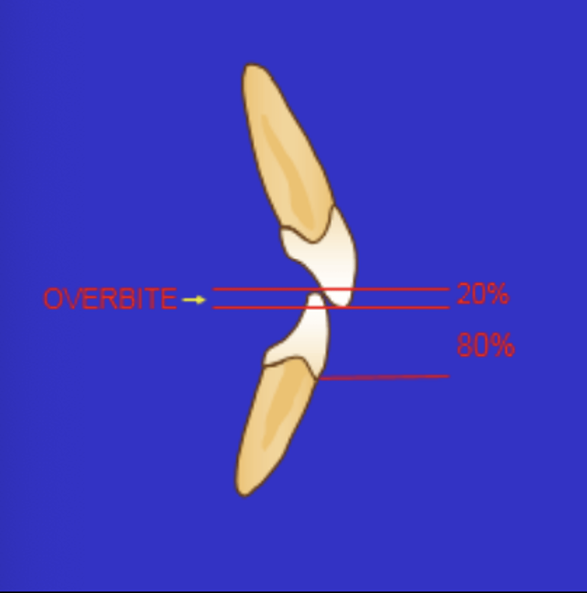 <p>Vertical relationship between the incisal edge of the maxillary central incisor and the incisal edge of the mandibular central incisors</p><p>- Given in a percent (Amount of the surface of the mandibular incisor crown that is covered by the maxillary incisor crown)</p>