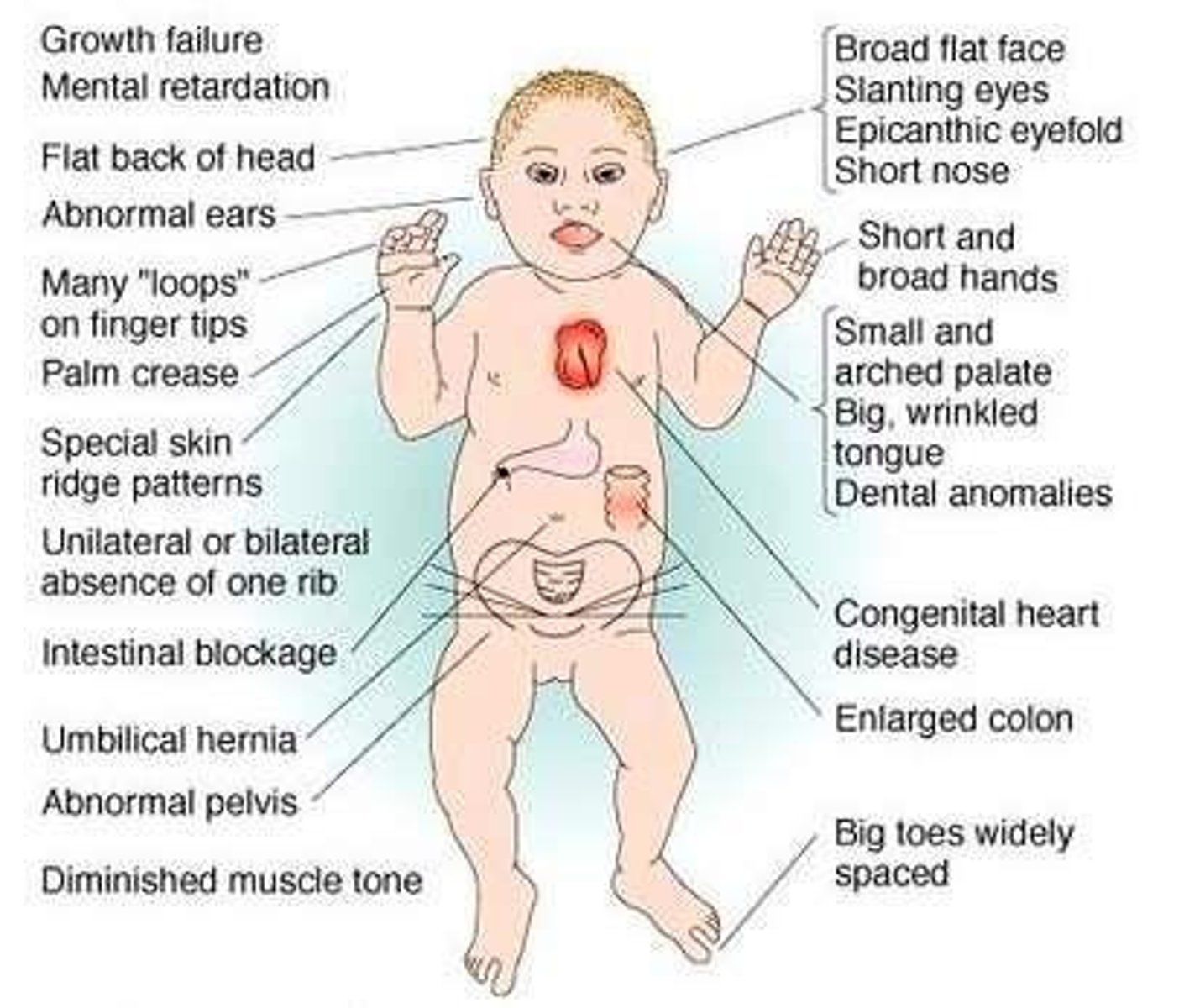 <p>Separated sagittal suture, enlarged anterior fontanel, small round head, flattened forehead, short broad neck, hypotonicity, protruding abdomen, hyperflexibility, and incurved fifth finger.</p>