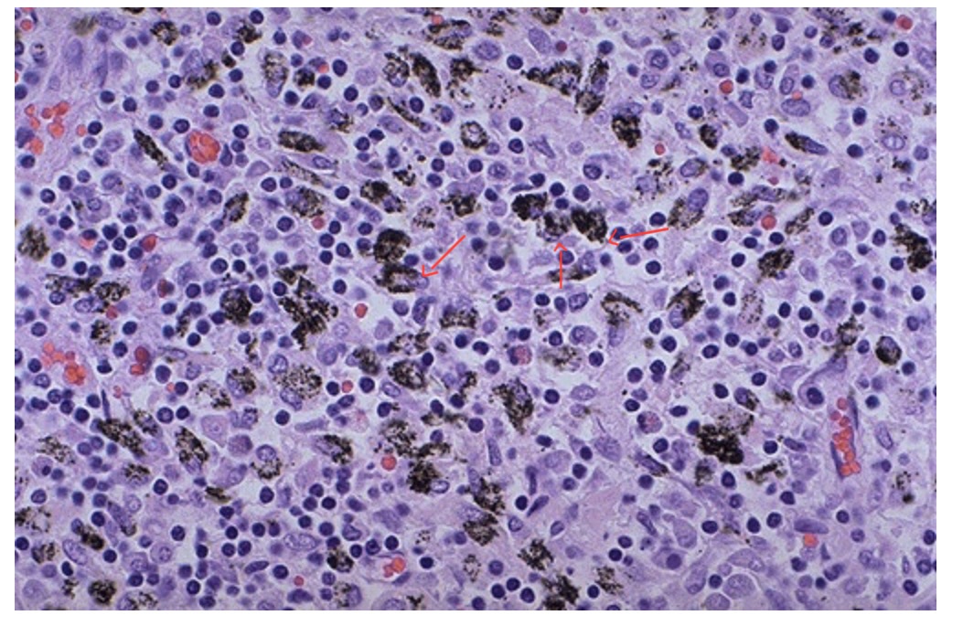 <ol><li><p>This condition is an accumulation of carbon from breathing dirty air.</p></li><li><p>What are the cells in this hilar lymph node that contains the dark pigment?</p></li></ol><p></p>