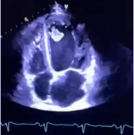 <p>Independent motion of part or whole thrombus.</p><p>Incidence for embolization and thromboembolic event is highest.</p>