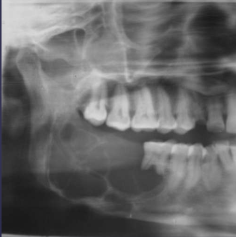 <ol><li><p>well circumscribed/corticated </p></li><li><p>radiloucent </p></li><li><p>unilocular/multilocular (course + curved septae if multi)</p></li><li><p>may arise in cyst wall </p></li></ol><p></p>