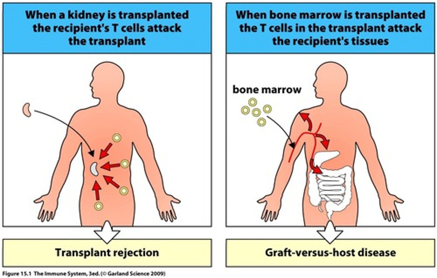 <p>IV reaction due to foreign antibodies creating Tc response</p>