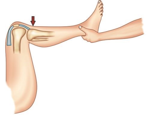 <p>Placera patientens knä och höft i 90 graders flexion, stöd den proximala och distala delen av underbenet, släpp det proximala greppet och notera eventuell dorsalförskjutning av tibia. Vid ökad dorsalförskjutning misstänks ruptur av bakre korsbandet.</p>