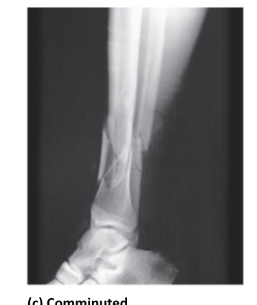 <p>fracture with more than 2 pieces</p>
