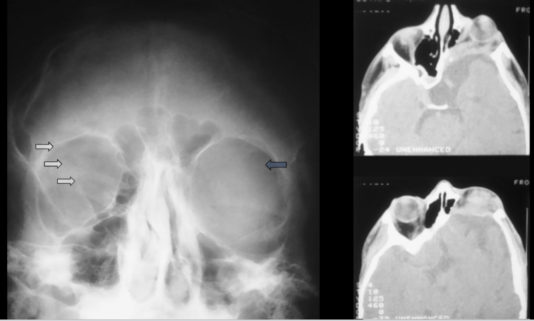 <p>what is seen here for this case of neurofibromatosis type 1?</p>