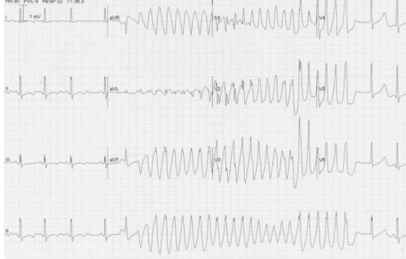 <p>What type of VT is this</p>