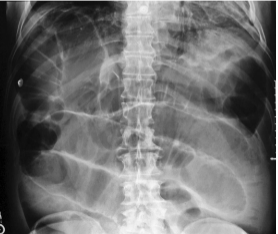 <p>Blockage of bowel lumen</p>