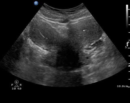 <ul><li><p>2 uterus</p></li><li><p>2 cervix</p></li><li><p>Failure of mullerian duct fusion </p></li><li><p>congenital anomaly </p></li></ul><p></p>