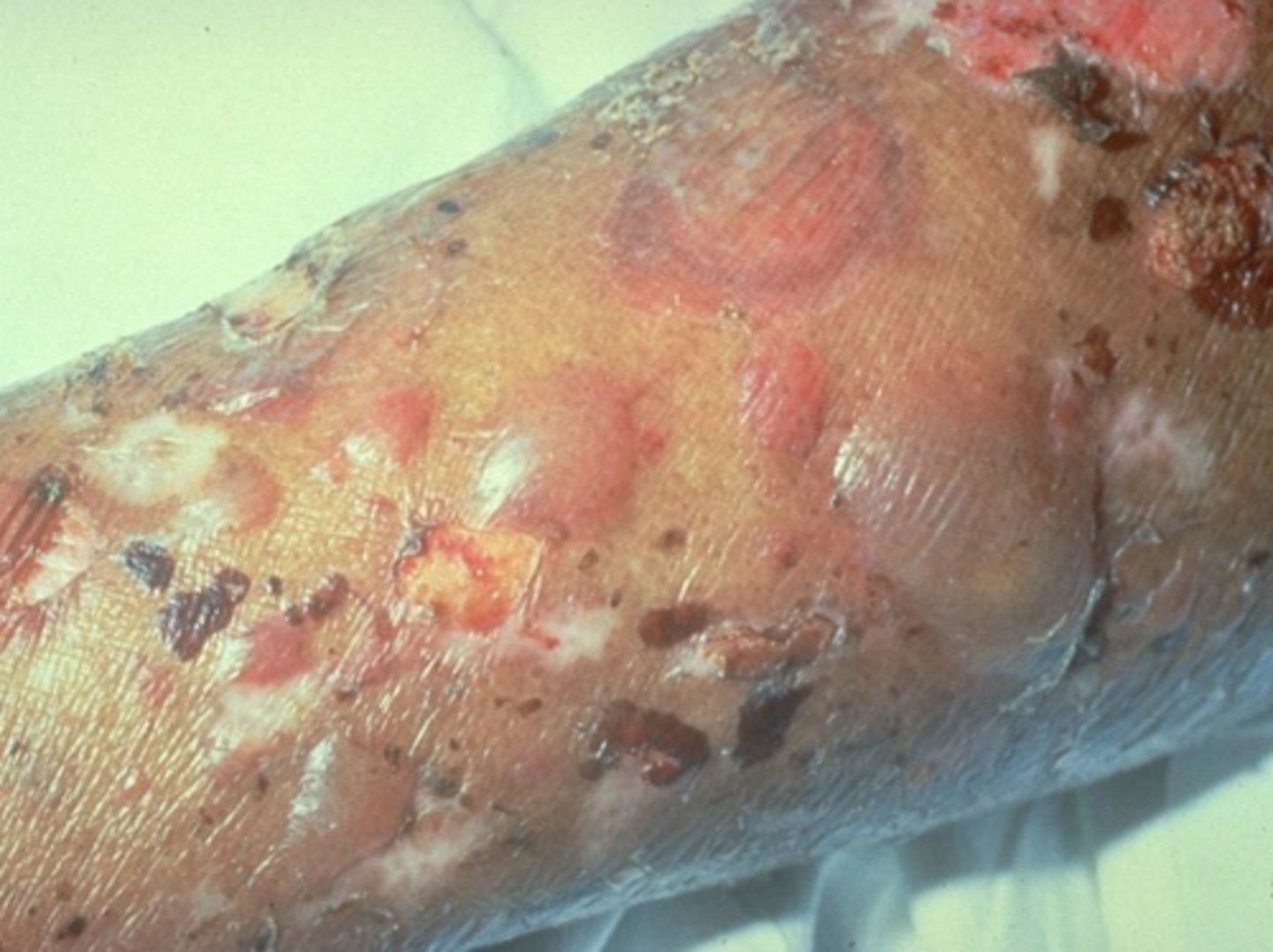 <p>diagnose this:</p><p>Epidermis sloughs/slips away when rubbed (+ Nikolsy's sign)</p>