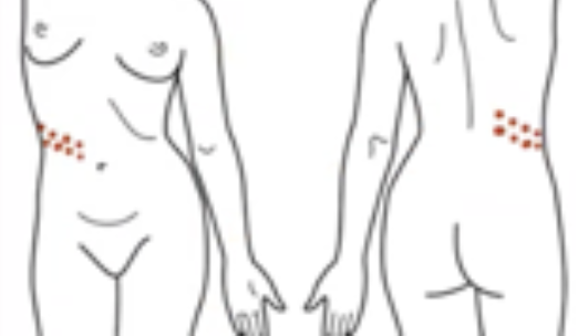 <p>Configuration of Skin Lesion</p><ul><li><p><strong>Spinal nerve root</strong> pattern</p></li><li><p><strong>Horizontal</strong> or <strong>tranverse</strong></p></li></ul><p></p>