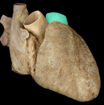 <p>Pulmonary trunk</p>