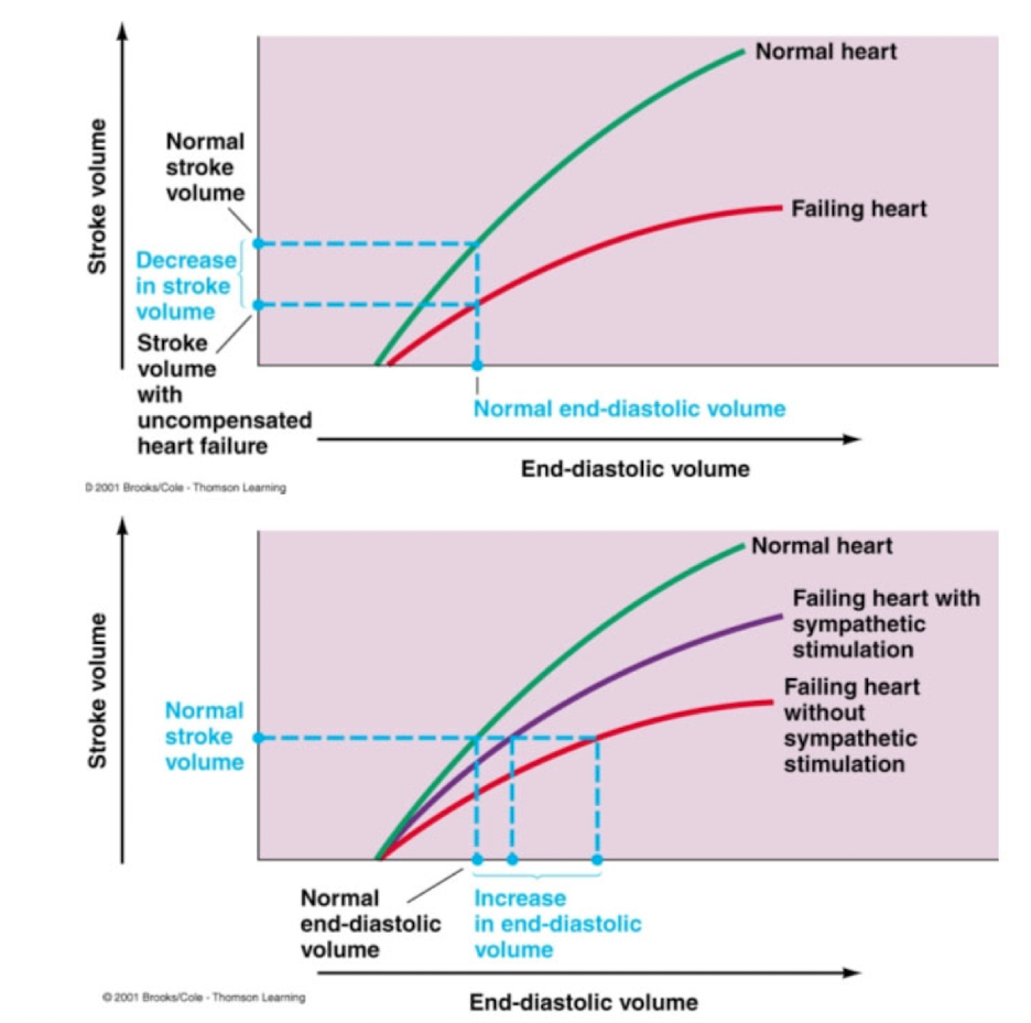 <ul><li><p>Decrease in cardiac contractility that shifts Frank Starling curve downward and to the right</p></li><li><p>Compensated for by increased sympathetic activity and increased blood volume due to retention of salt and water by the kidneys</p></li></ul><p></p>