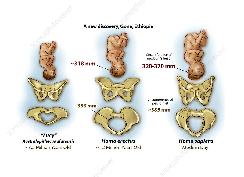 <p>Pelvic adaptations to bipedalism in humans. </p><ul><li><p>As we developed bipedalism, our physical skeleton changed and reflected anatomic differences to support this mechanical need, which in this case is a shorter pelvis. </p></li></ul><p>Tight fit in the birth canal as brain size increases during human evolution. </p><p></p><p>Maybe babies are born with smaller brains because there are physical constraints that limit the birth process without severely endangering the mother and baby. </p>