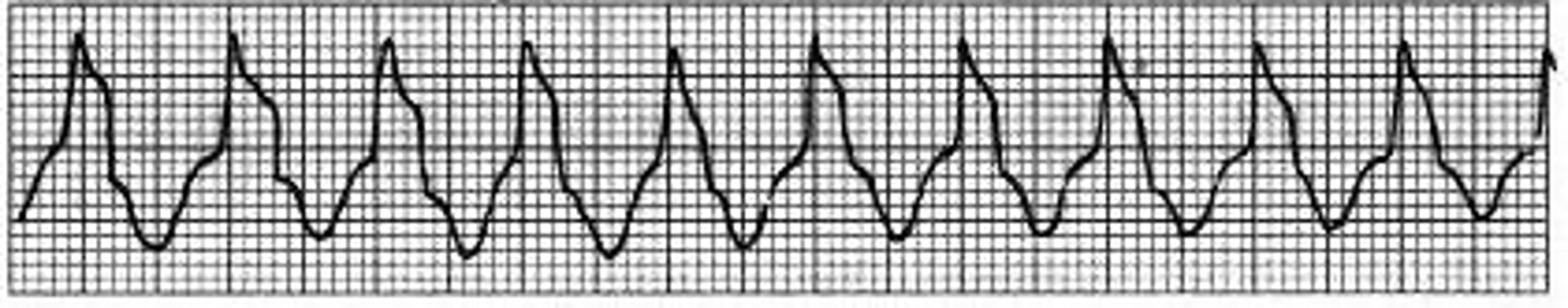 <p>Sudden rapid firing of irritable ventricular focus producing AV dissociation (independent pacing of atria &amp; ventricles) as well as wide QRS complexes</p>