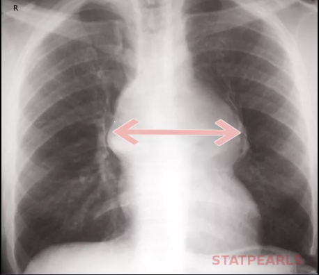 <p>Which abdominal emergency presents with <span style="color: red"><strong>sudden, severe, maximal intensity pain at onset of chest or midline abdominal pain</strong></span> and may show <span style="color: blue"><strong>widening of mediastinum on CXR?</strong></span></p>