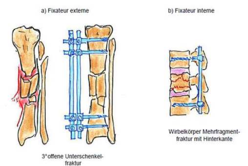 <p>Operative Frakturbehandlung</p><p><strong>Fixateur externe - Fixateur interne</strong></p><p><strong>a)</strong>&nbsp;Minimal Schrauben in Knochen, möglichst wenig Weichteilschädigung, durch äußere Spannung, potentielle Keimschleuder</p><p><strong>b)</strong> Stäbe sind innen statt außen, aber nicht direkt an der Fraktur</p>