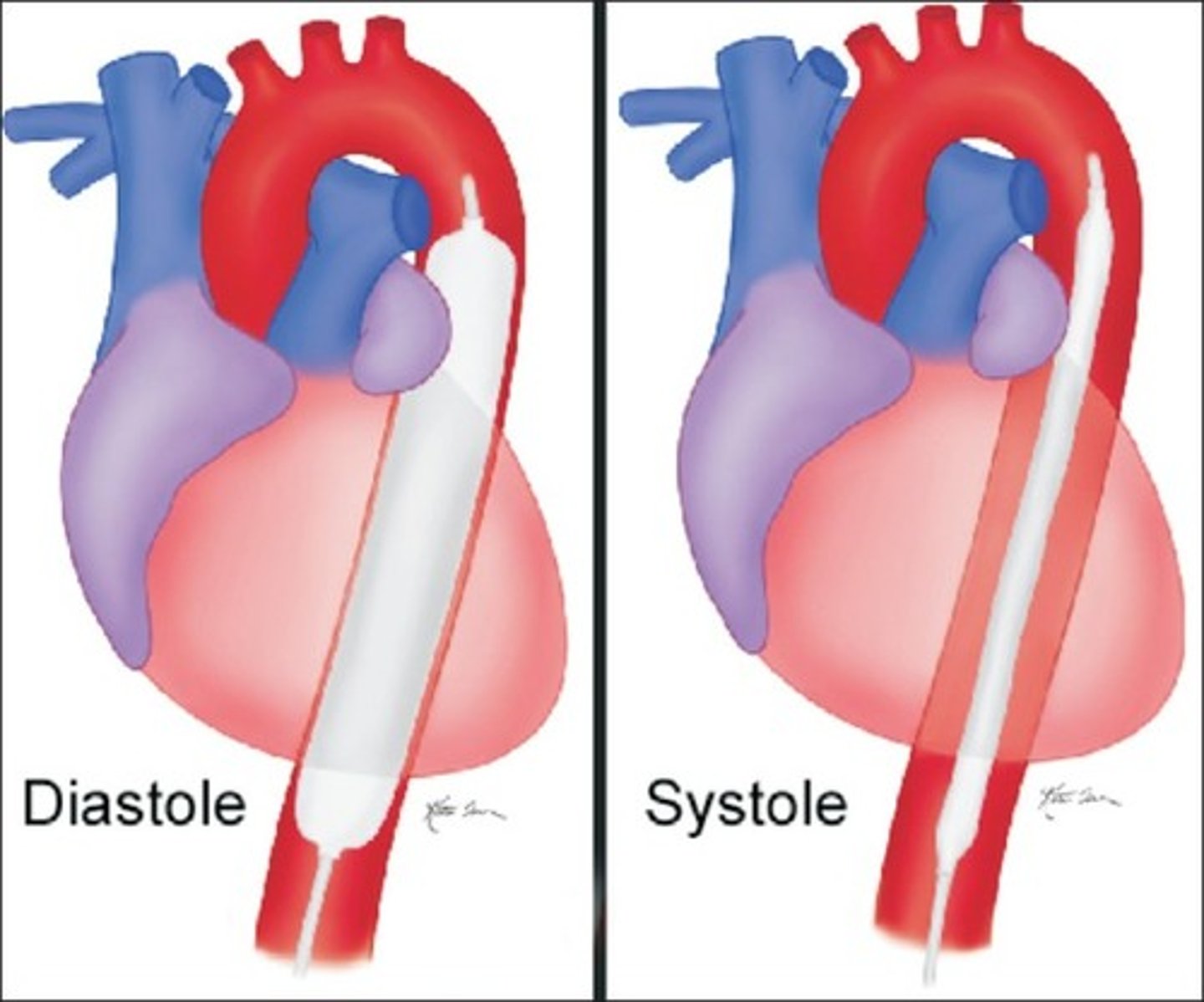 <p>intra-aortic balloon pump; used to support patients in cardiogenic shock</p>