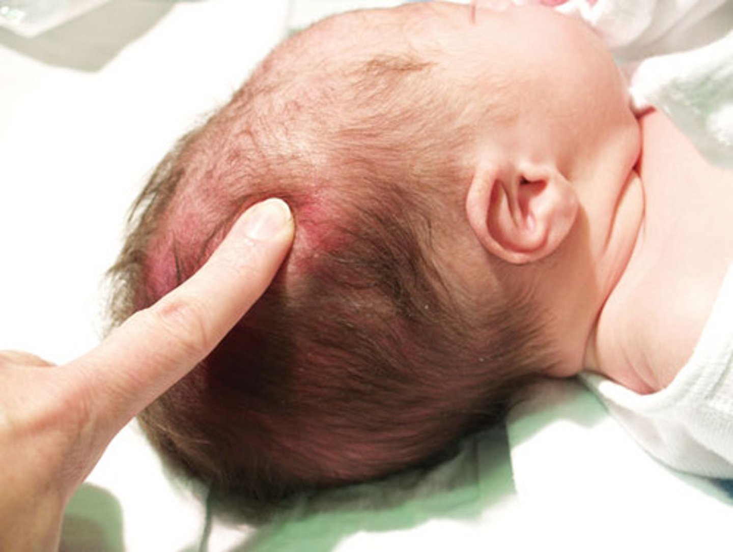 <p>-the temporary shaping of the baby's head during labor and birth</p><p>-bones of a baby's skull are not fully fused, which allows them to overlap slightly as the baby passes through the birth canal</p>