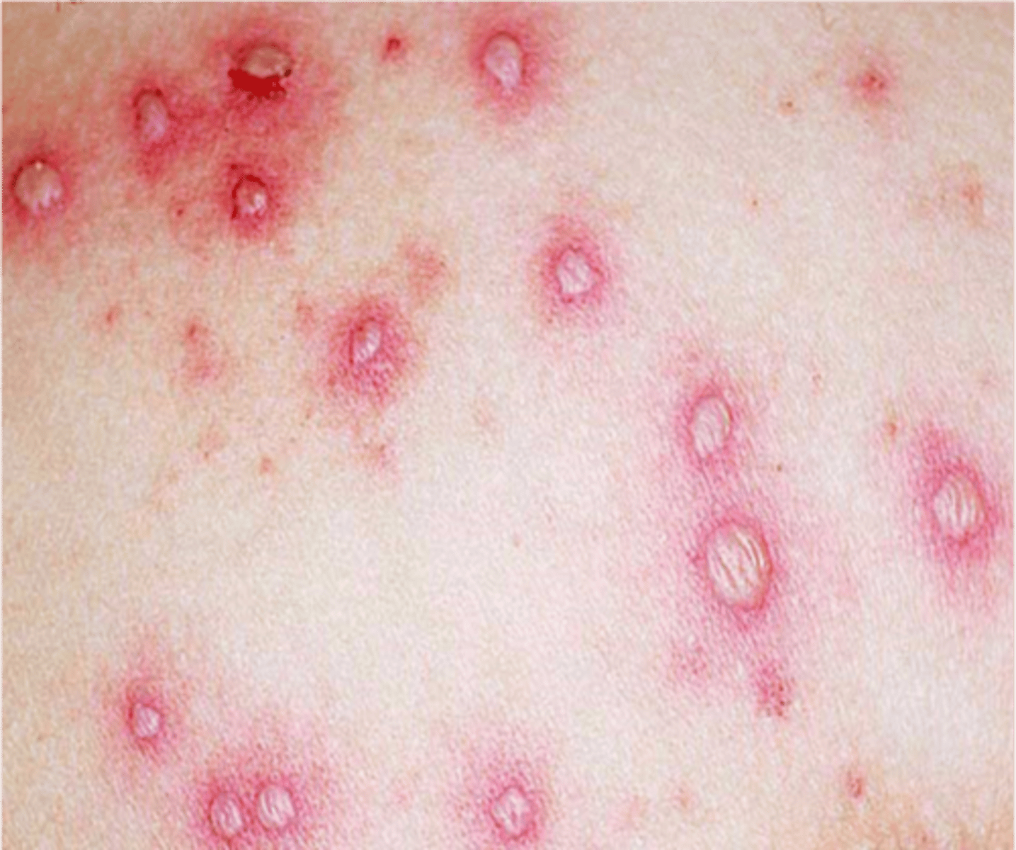 <p>• Small fluid filled lesion on or below the skin</p><p>• Circular lesions</p><p>• &lt;1 cm in diameter</p>