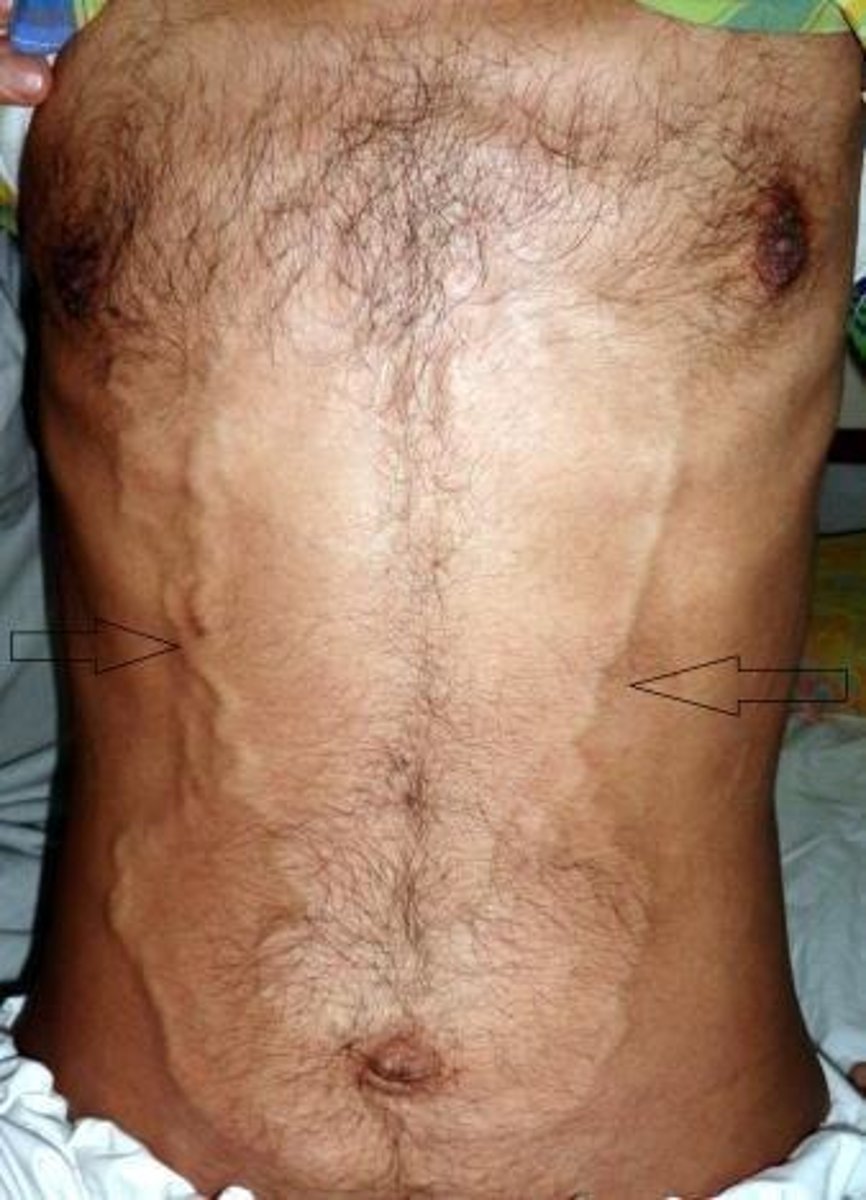 <p>Tortuous vessels around the umbilicus caused by portal HTN</p>