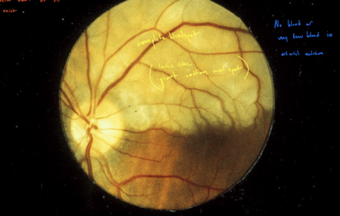 <p>rapid anoxia of inner retina</p><p>cause anoxia that causes loss of inner retinal layers (NFL, GCL, IPL, INL) - retinal tissue changes from hazy to white in a few hours</p><p>image would be considered hemicentral technically</p>