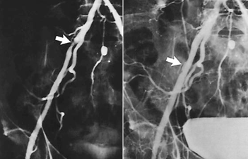 <p>this is atherosclerosis, waht is the treatment </p>
