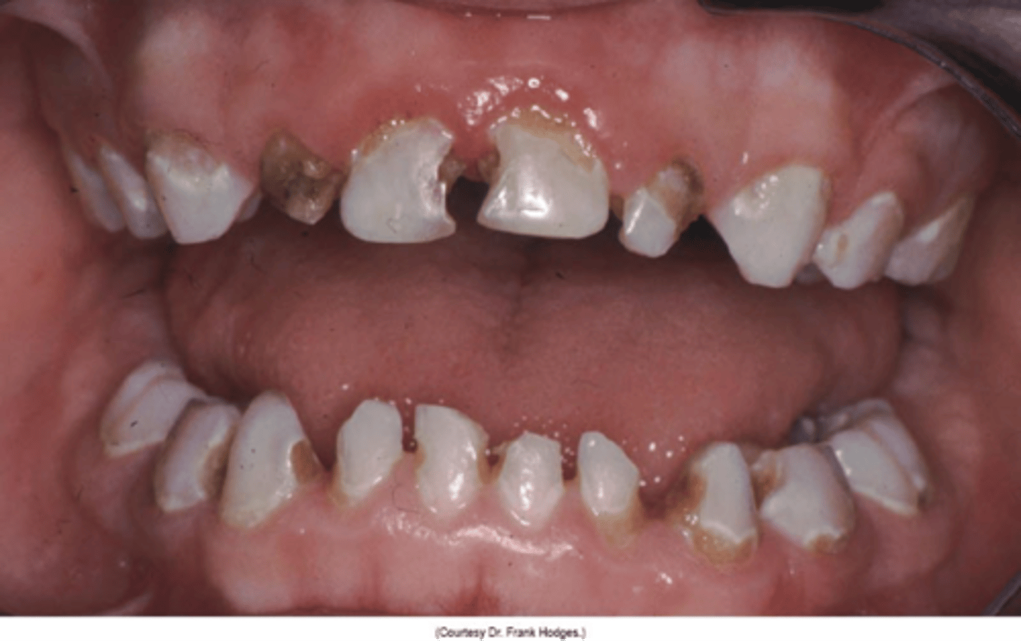 <p>Any dental caries in first 3 years</p><p>Nursing bottle syndrome</p>
