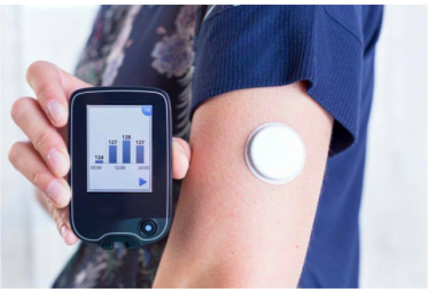 <p>CGM - continuous blood glucose monitoring</p>