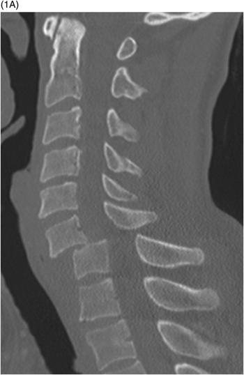 <p>bilateral locks facet</p>