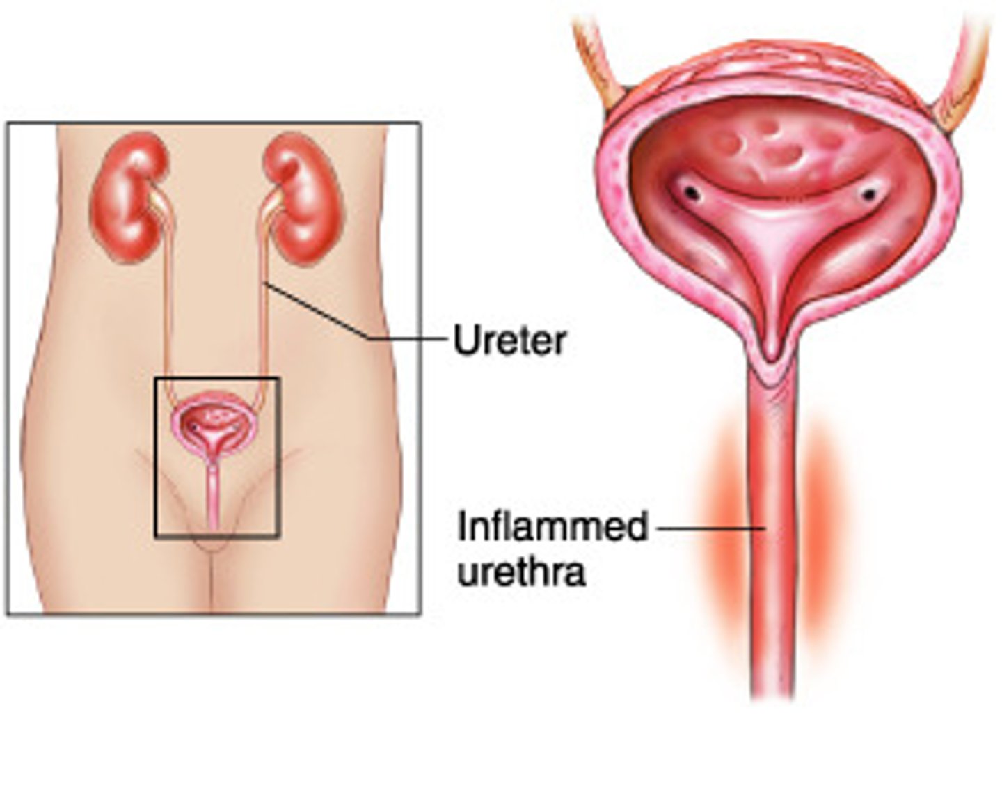 <p>inflammation of the urethra and the bladder</p>