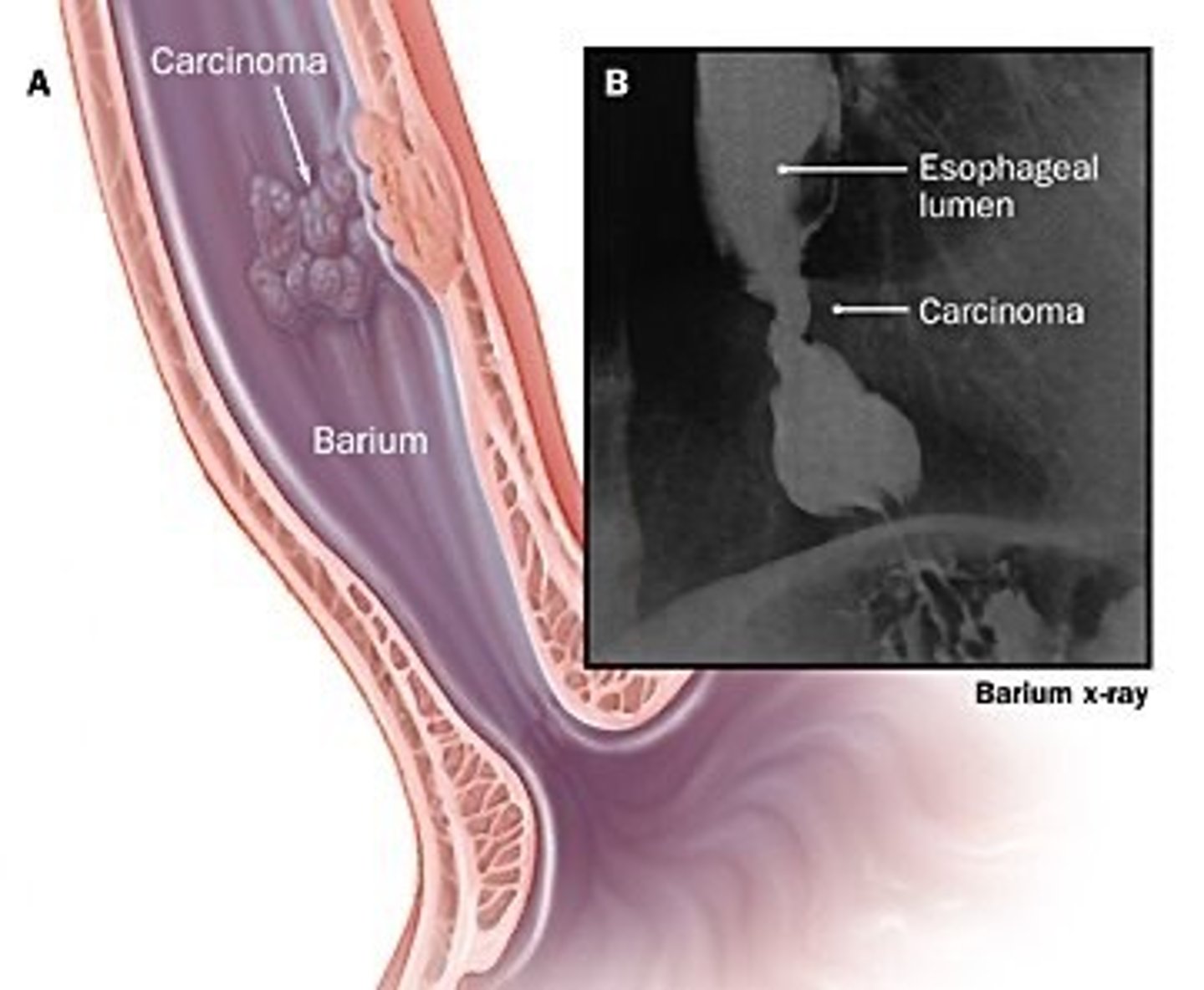 <p>Define Condition:</p><p>Resulting from cancerous mass of esophagus protruding into lumen</p><p>-Sx: Dysphagia</p>