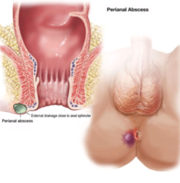 <p>Anal Fistula</p>