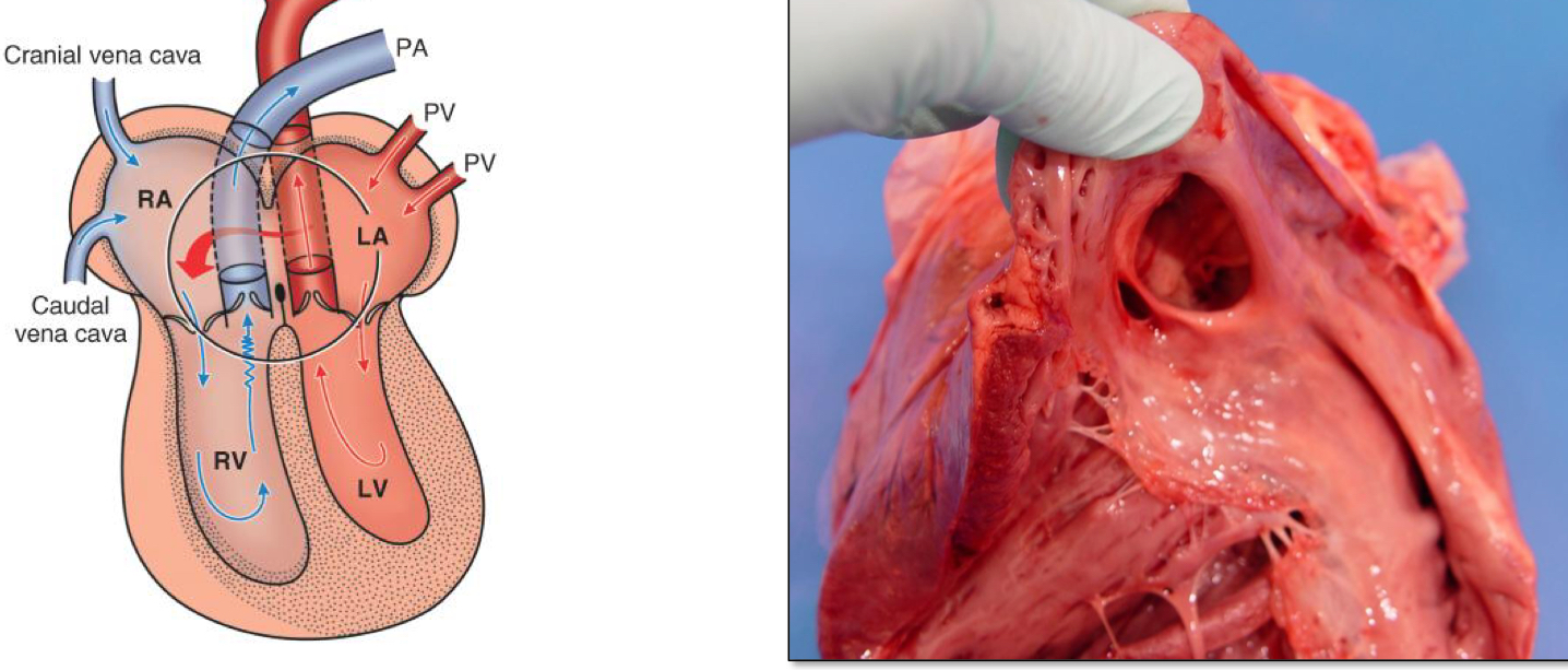 <ol><li><p>Blood Shunts from LA to RA</p></li><li><p><span style="color: rgb(0, 113, 255);">Inc</span> of Blood volume in the right ventricle</p></li><li><p><u>Volume overload of RV</u></p></li><li><p>RV essentric hypertrophy</p></li></ol><p></p>