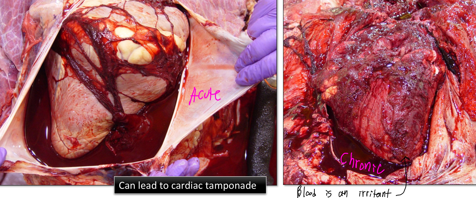 <ul><li><p>Blood in the pericardial sac</p><ul><li><p>Can be acute/chronic (tissue will appear red because blood is an irritant)</p></li></ul></li></ul><p></p>