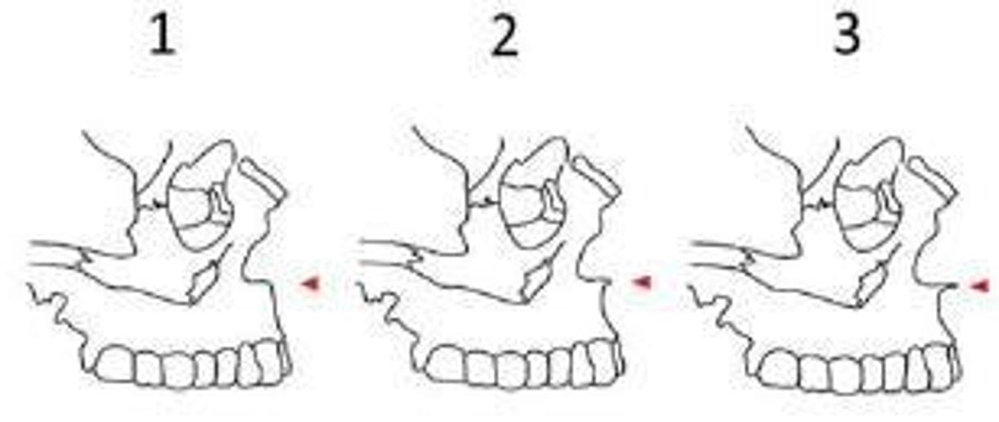 <p>Bony growths on the mandible that can vary in size and presence among populations.</p>