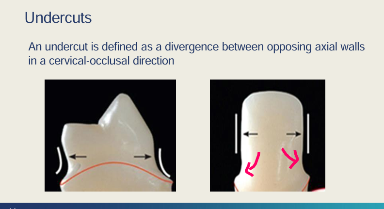 <ul><li><p>An undercut is defined as divergence between opposing axial walls in a cervical-occlusal direction</p></li><li><p>Crown won’t sit </p></li><li><p>unfavourable</p></li><li><p>when you make a temp crown and try to take it off, it will fracture</p></li></ul><p></p>