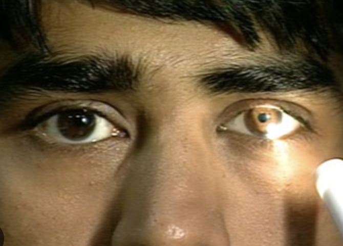 <p>How to test <strong><em>12. Pupillary reaction to light</em></strong>?</p>