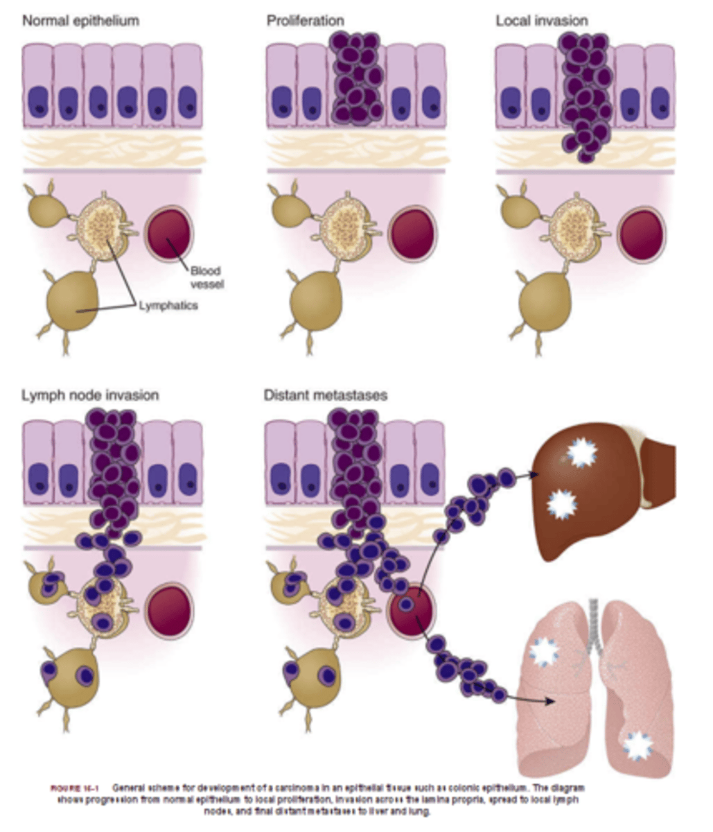 <p>- cancer that can <b>invade</b><br>- can <b>split up</b><br>- <b>spreads around</b> the body and <b>harm other</b> healthy tissues: <b>lodges</b><br>- gets into the <b>blood stream</b><br>- <b>live longer</b> than other cells<br>- life threatening <br>- harm organs<br>- grows beyond size of benign tumour</p>