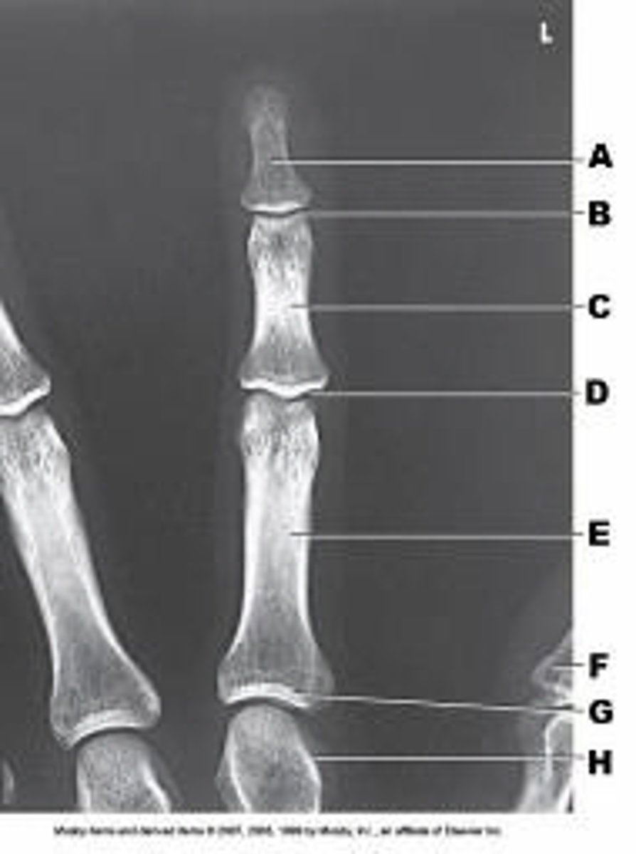 <p>What anatomy of the third digit is labeled as letter D in the figure above?</p><p>Distal IP joint</p><p>Proximal IP joint</p><p>Metacarpophalangeal joint</p><p>Carpometacarpal joint</p>
