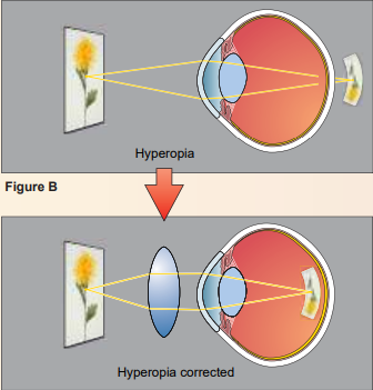 <ul><li><p>Farsightedness</p></li><li><p>Eye is too short → Can see far away but near objects focus behind the retina</p></li><li><p>Corrected with concave lenses</p></li></ul>