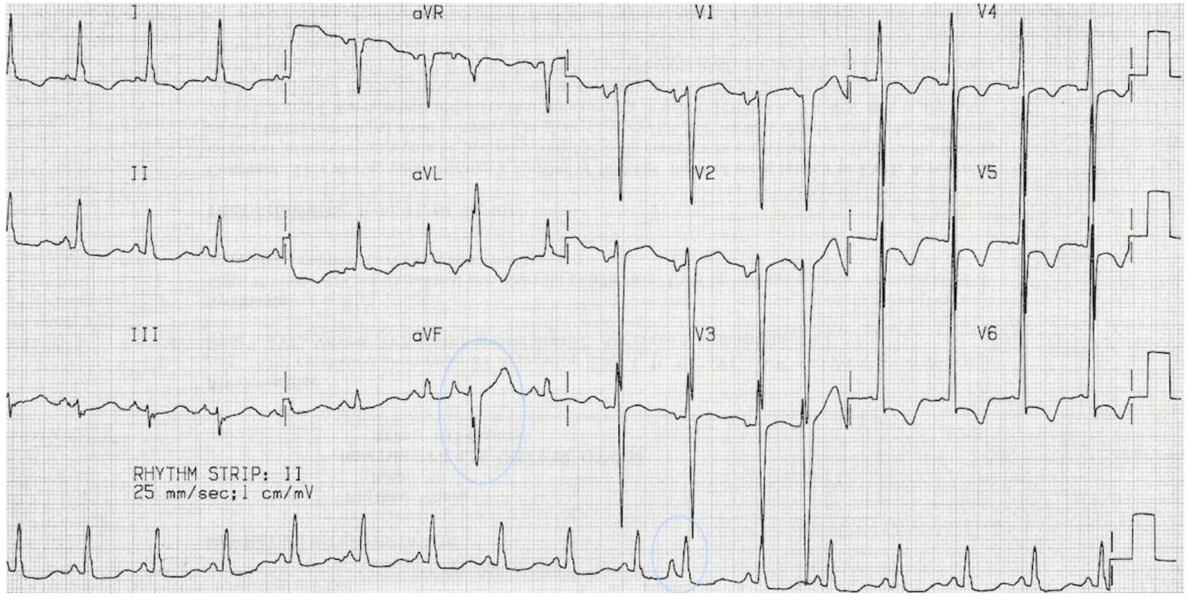 <p>Treatment for a patient throwing PACs with palpitations</p>