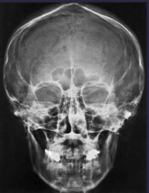 <ul><li><p>frontal + ethmoid sinuses</p></li><li><p>nasal fossa + orbits</p></li></ul><p></p>