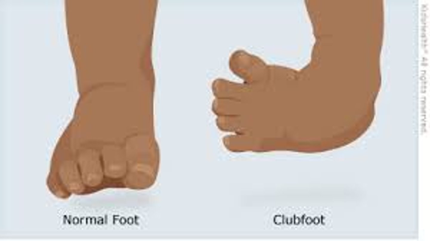<p>Complex deformity of the foot and ankle.</p><p>-Occurs as an isolated defect</p><p>-Or may be associated with other disorders (cerebral palsy, spina bifida)</p>