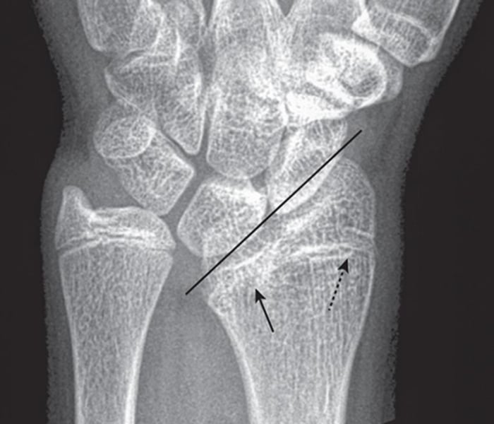 <p>What type of fracture is this?</p>