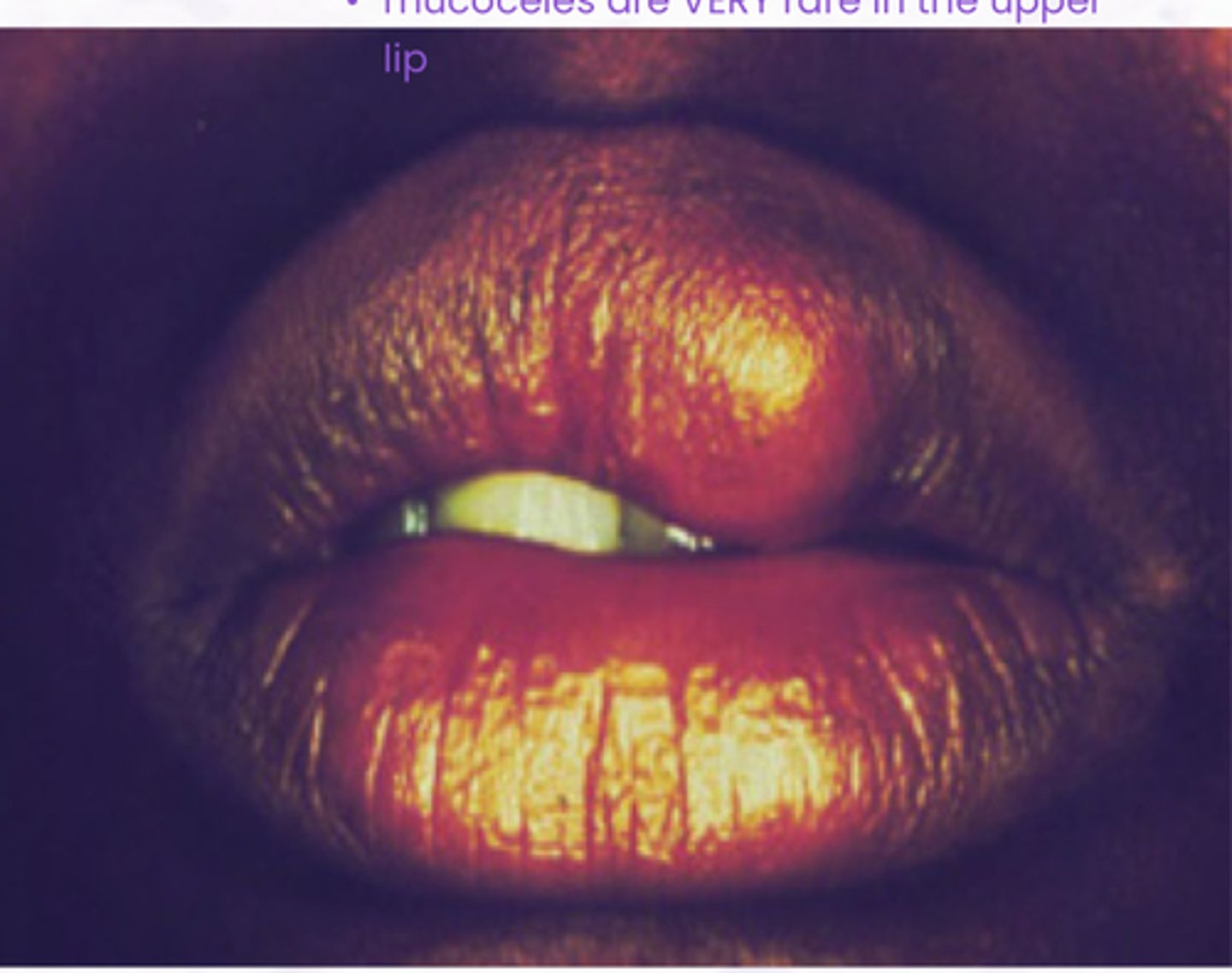 <p>Benign Salivary Gland Tumors:</p><p>Most common site is the upper lip, bluish, happens most in middle aged females &gt;50yrs</p>