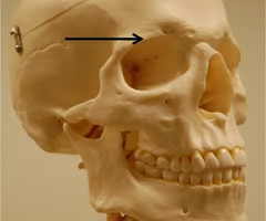 <p>thick margin of the eye socket that lies beneath the eyebrows</p>